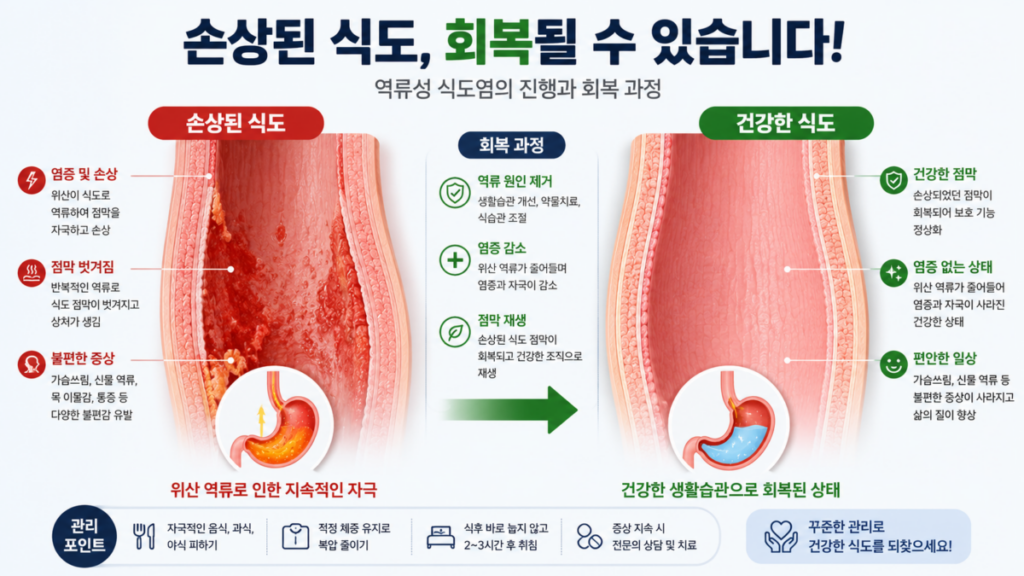 역류성 식도염으로 손상된 식도 점막과 회복된 식도 점막을 비교한 의료 일러스트
